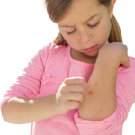 子供の蕁麻疹は何科？原因不明、汗やストレス、疲れでも出る？お風呂や病院は？
